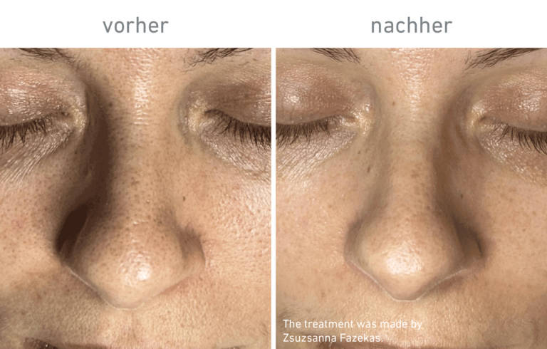Belico Vorher-Nachher Ergebnis