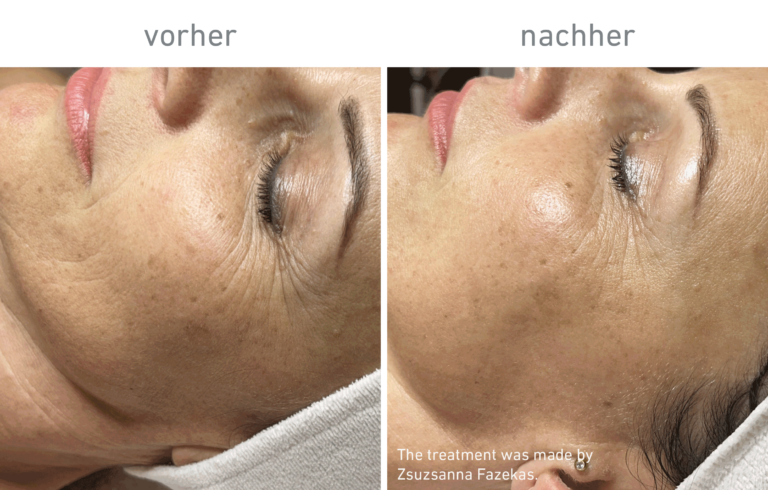 Belico Vorher-Nachher Ergebnis