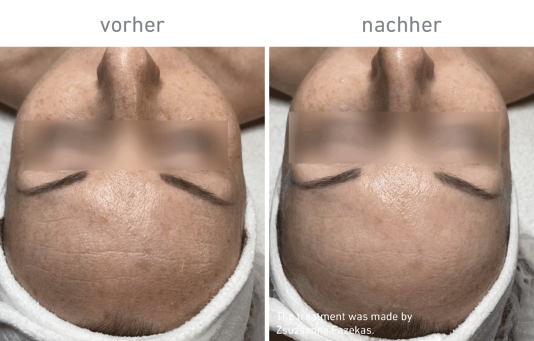 Belico Vorher-Nachher Ergebnis