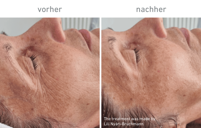 Belico Vorher-Nachher Ergebnis