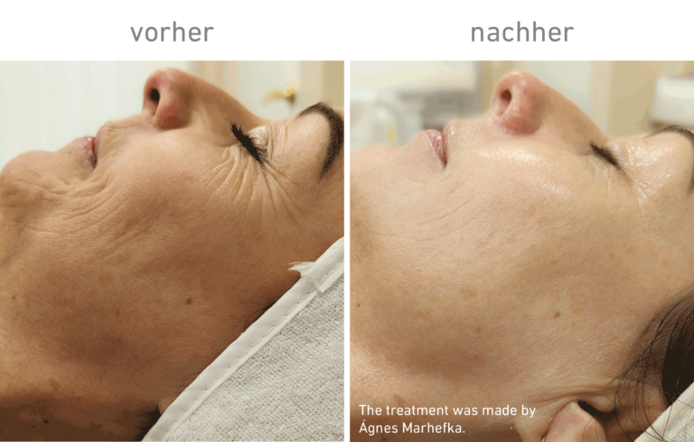 Belico Vorher-Nachher Ergebnis