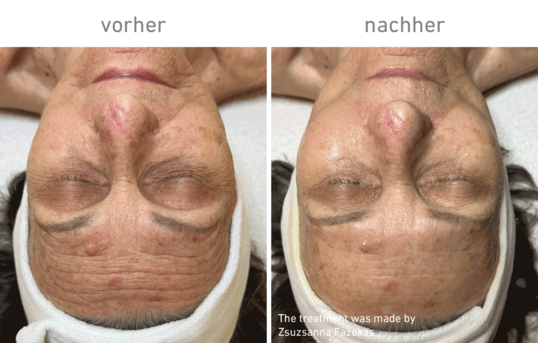 Belico Vorher-Nachher Ergebnis