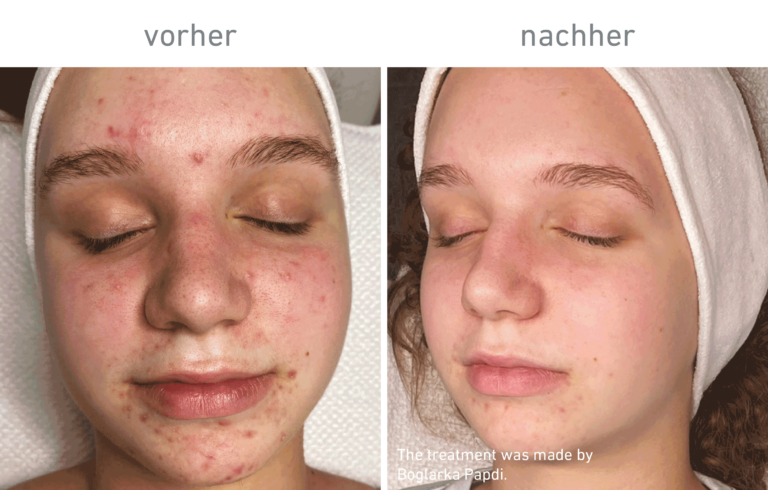 Belico Vorher-Nachher Ergebnis