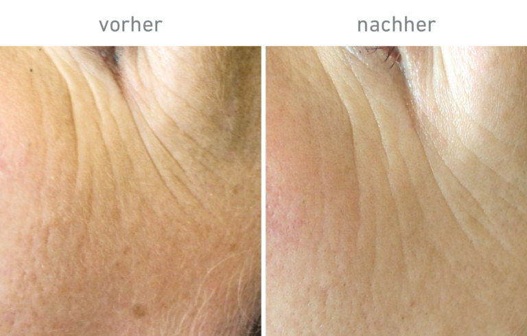 Belico Vorher-Nachher Ergebnis