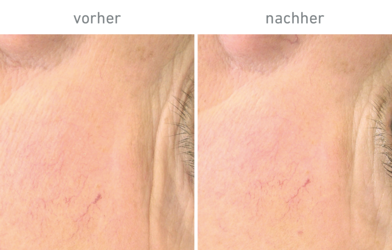 Belico Vorher-Nachher Ergebnis