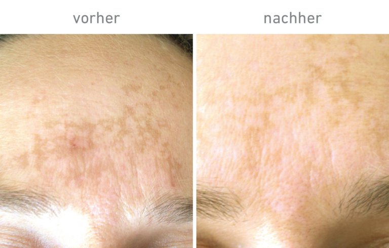 Belico Vorher-Nachher Ergebnis