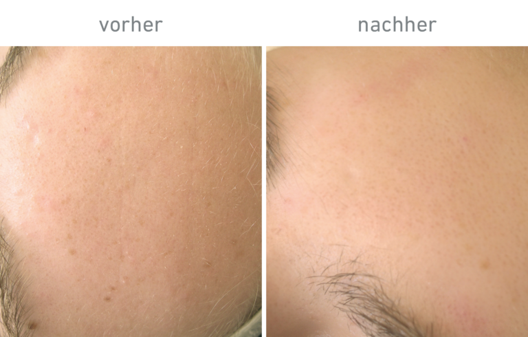 Belico Vorher-Nachher Ergebnis