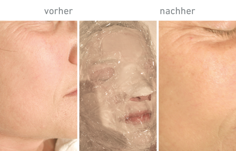 Belico Vorher-Nachher Ergebnis