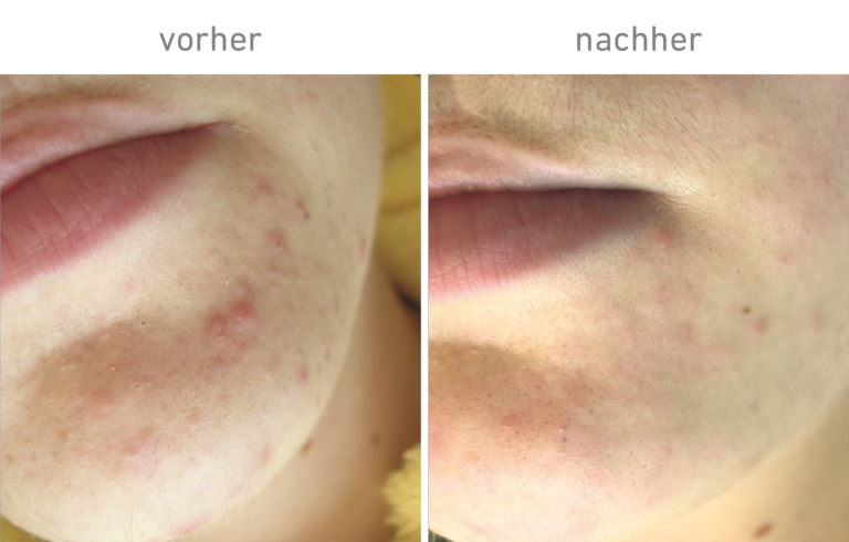 Belico Vorher-Nachher Ergebnis