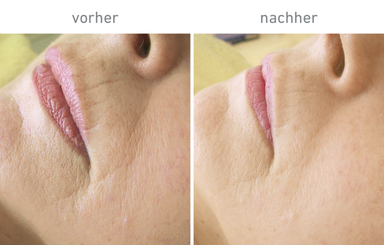 Belico Vorher-Nachher Ergebnis