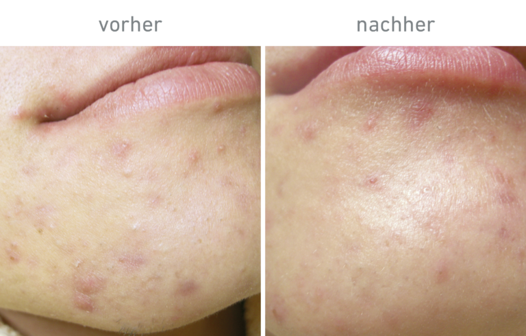 Belico Vorher-Nachher Ergebnis