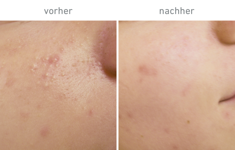 Belico Vorher-Nachher Ergebnis