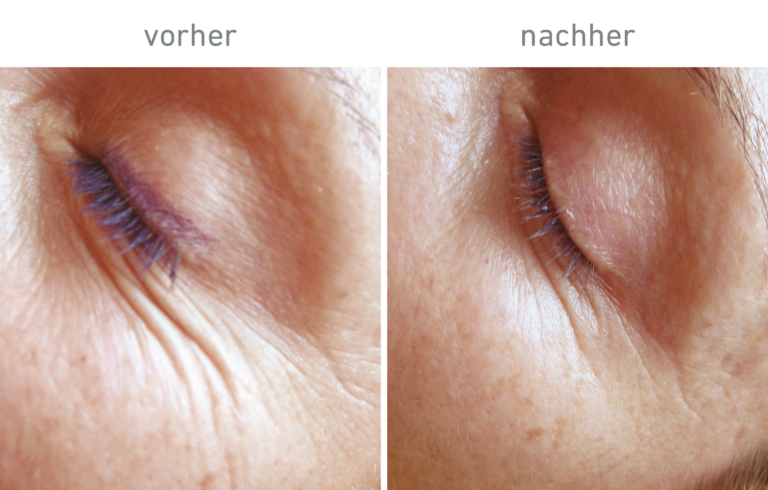Belico Vorher-Nachher Ergebnis