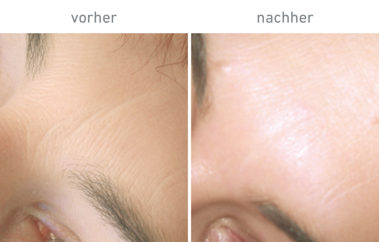 Belico Vorher-Nachher Ergebnis