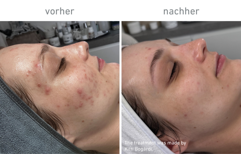 Belico Vorher-Nachher Ergebnis
