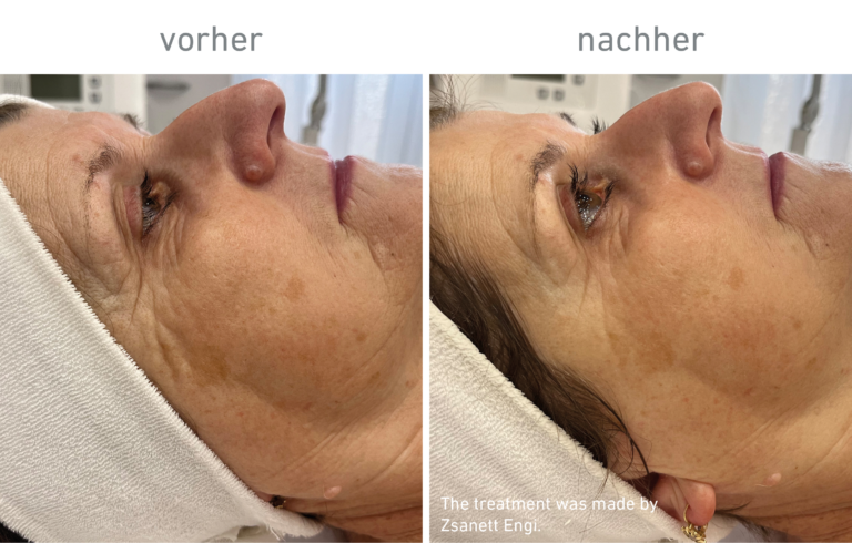 Belico Vorher-Nachher Ergebnis