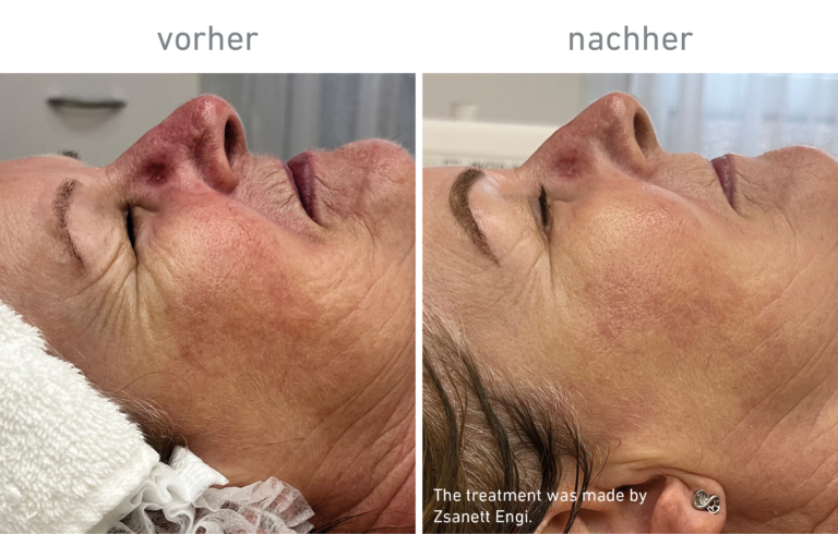 Belico Vorher-Nachher Ergebnis