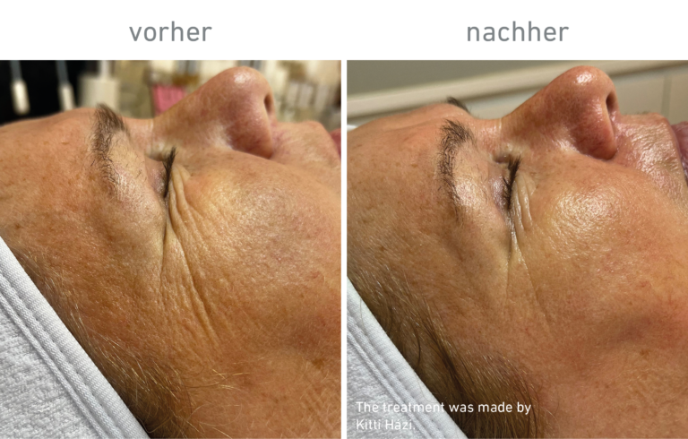 Belico Vorher-Nachher Ergebnis