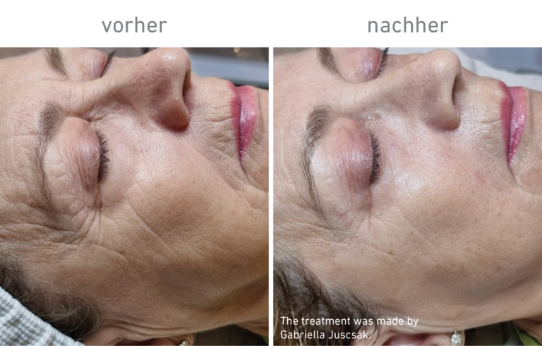 Belico Vorher-Nachher Ergebnis